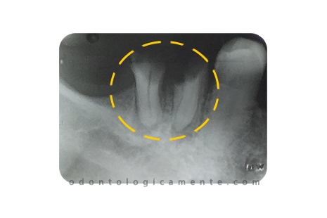 fractura dental radiografía